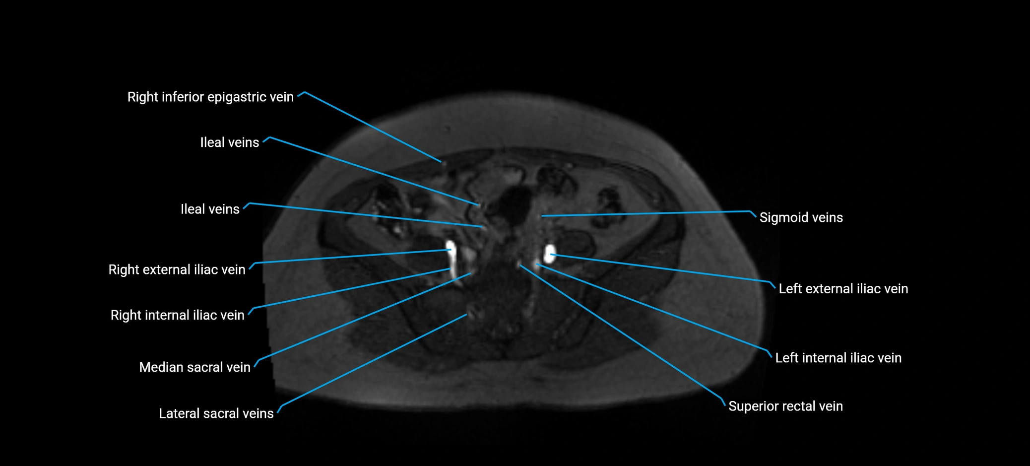 MRV abdomen pelvis & lower limb axial cross sectional anatomy labelled MRI image 135 (1).webp